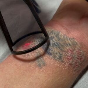 Remoção de Tatuagem a Laser